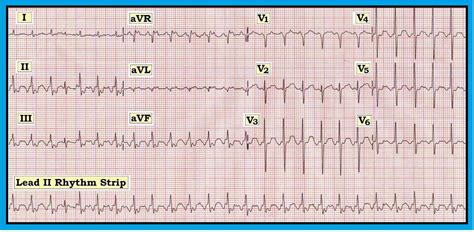 Common dysrhythmias in children, especially in infancy. ECG Interpretation: ECG Interpretation Review #40 (Regular ...