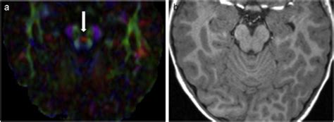 Neuroimaging Findings In Joubert Syndrome With C5orf42 Gene Mutations