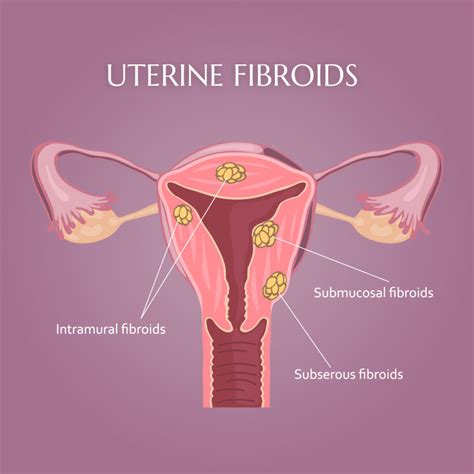 Uterine Fibroids Symptoms Treatment Causes Types Sexiz Pix