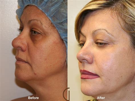 Facial Fat Grafting Before And After Photos Patient 03 Dr Kevin Sadati
