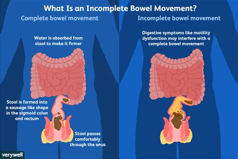 How To Reduce Symptoms Of Incomplete Defecation Bowel Movement Symptoms Sigmoid Colon