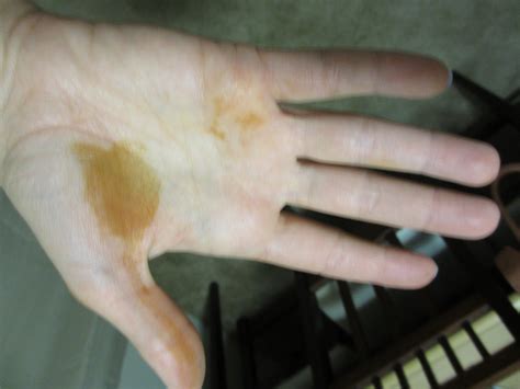 What Causes Brown Spots On Palms Of Hands