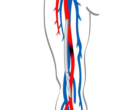 Spiral Flow Peripheral Bypass Graft Vascular Flow
