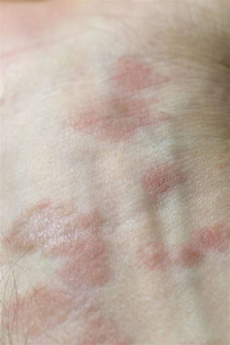 Allergic Eczema Causes Symptoms And Pictures