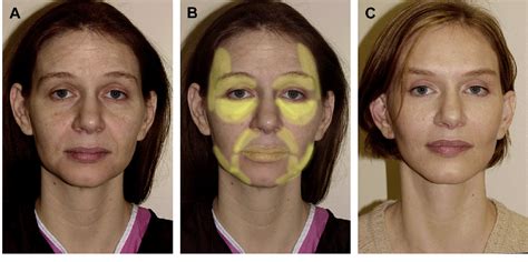 Figure 2 From Fat Grafting In Facial Rejuvenation