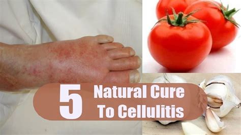 5 Home Remedies For Cellulitis By Top 5 Youtube