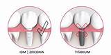 Pictures of Zirconium Dental Implants Side Effects