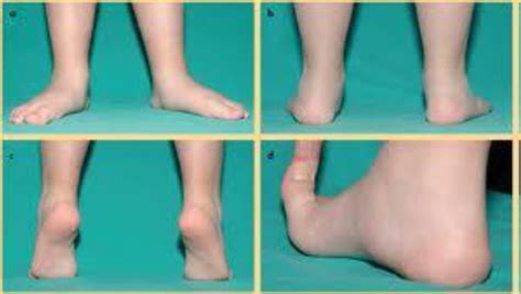 Childrens Foot Problems Bath Podiatry