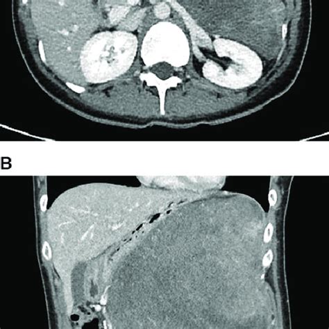 Contrast Enhanced Abdominal Computed Tomography A Transverse View Of