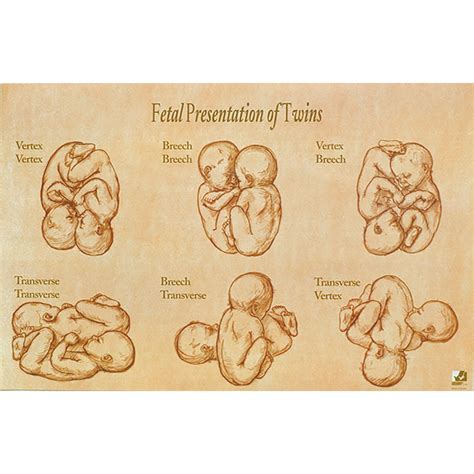 Fetal Development And Presentation Of Twins Chart 1018282 W43094