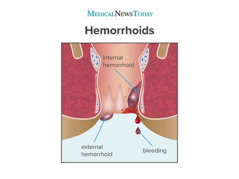 In their normal state, they are cushions that help with stool control. Hemorrhoids during pregnancy: Symptoms, treatment and more