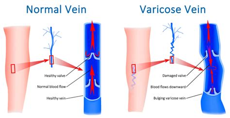 Varicose Veins Overview Symptoms And Diagnosis