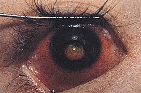 Vitamin A Deficiency And Xerophthalmia In An Autistic Child Jama