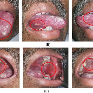 (PDF) Oral mucositis severity in patient with head and neck cancer