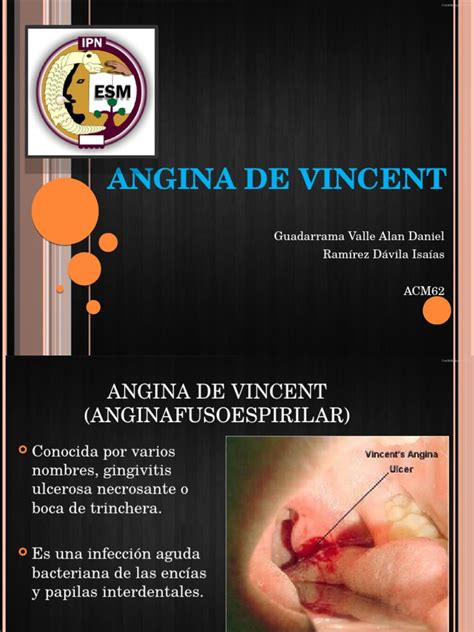 Angina De Vincent Enfermedades Y Trastornos Medicina Clinica