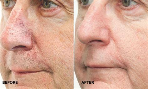 Iplbbl Photofacial Rejuvenate Renew And Restore The Skin