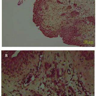 Antitumor effect of high-/low-dose BCG treatment on the ...
