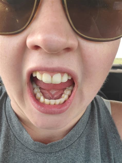 Any thoughts on plan : smiledirectclub