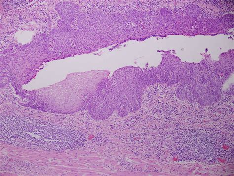 Pathology Outlines Esophageal Carcinoma Overview