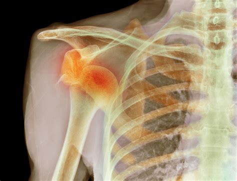 Shoulder Dislocation Symptoms And Treatment
