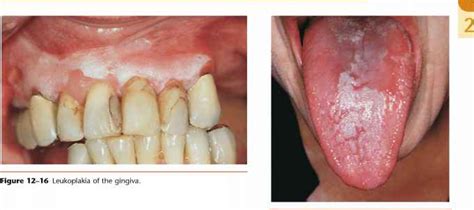 White Bumps On Buccal Mucosa