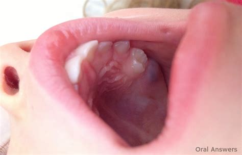 Eruption Cyst A Purple Blue Bump On Your Babys Gums Oral Answers