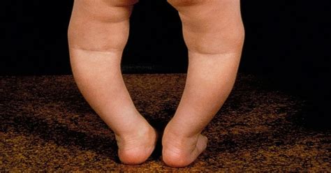 Rickets In Children Symptoms And Treatments