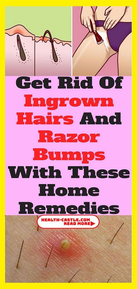 Get Rid Of Ingrown Hairs And Razor Bumps With These Home Remedies Hairs