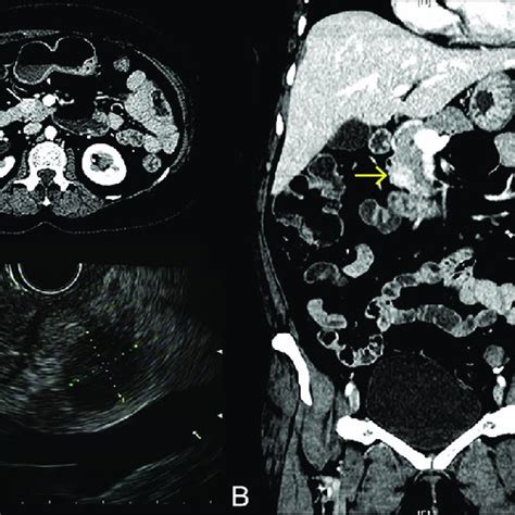 Radiology Features Of The Pancreatic Lesion Contrast Enhanced Computed