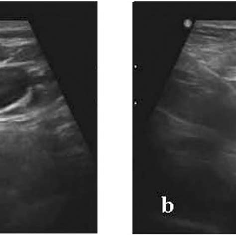 Us Of Solitary Thyroid Nodule A Solid Nodule 2 Points Taller Than