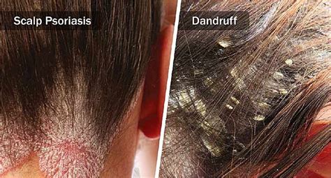 Know The Difference Dandruff Vs Dry Scalp