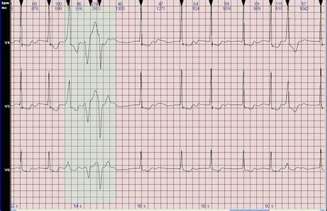 心电图图例分析：窦性心律，短阵多形性室性心动过速，室性早搏 - 爱爱医医学网