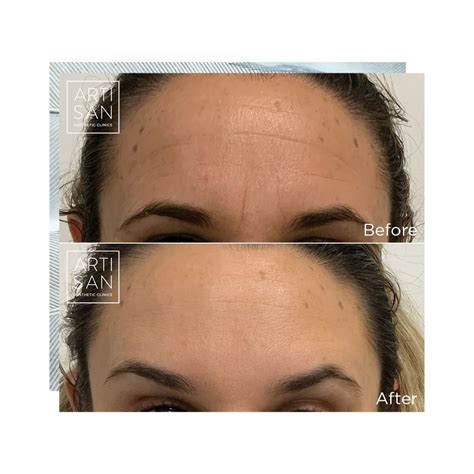 Anti Wrinkle Injections Artisan Aesthetic Clinics