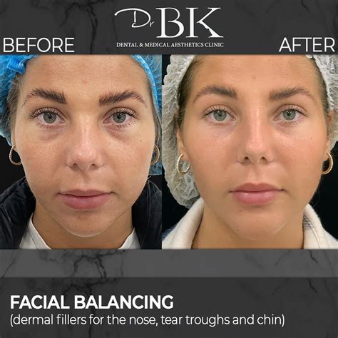 Full Face Treatment Drbk Cosmetic Dentist And Aesthetics Clinic