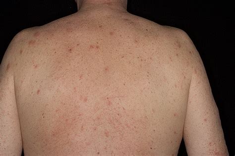 Eczema On The Back Pictures 40 Photos And Images