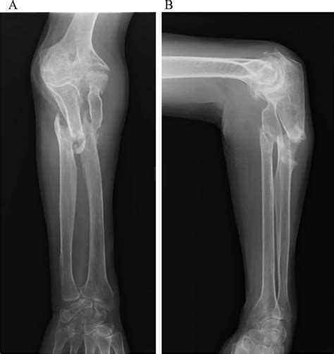 Forearm X Ray Anatomy