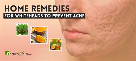9 Best Home Remedies For Whiteheads To Prevent Acne