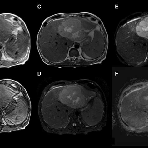Follow Up Ct Scans Before And After Intravenous Injection Of Iodine