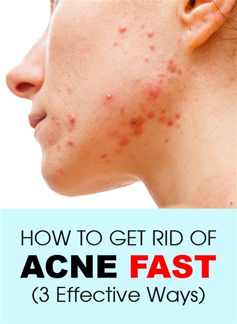 If you've recently taken a course of antibiotics or you have a chronic condition that affects your immune system (such as autoimmune disease or diabetes). How To Get Rid of Acne Fast (3 Effective Ways) - Fashion Daily