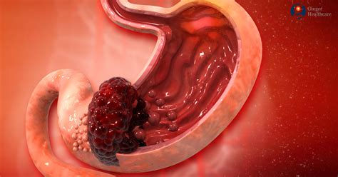 When stomach cancer does cause signs and symptoms, they can include: Stomach Cancer: Causes, Symptoms, Diagnosis & Treatment ...