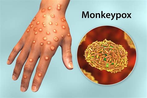 Cdc Experts Update On Monkeypox In The United States
