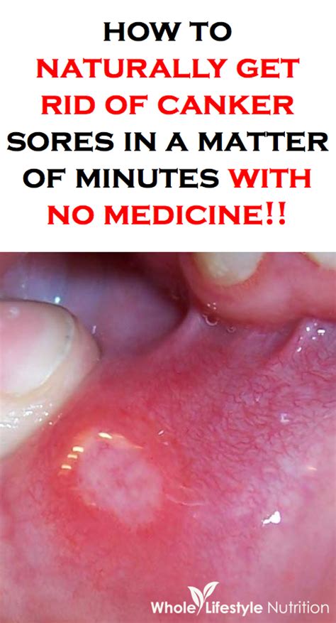 How To Naturally Get Rid Of Canker Sores In Minutes With No Medicine