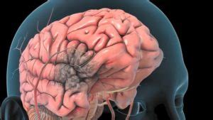 Trombose Arterial Cerebral O Que Causas Sintomas E Tratamento