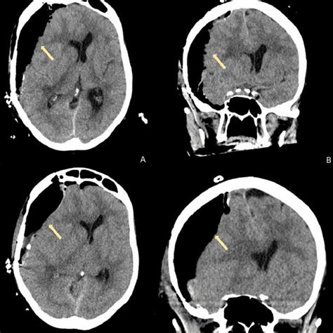 Computed Tomography Imaging Of The Head After Subdural Hematoma