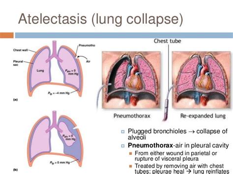 atelectasis | Pediatric nursing, Pediatric nurse practitioner, Nursing