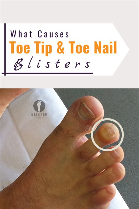 Toenail Blisters 7 Causes 7 Fixes Toe Nails Blister Treatment