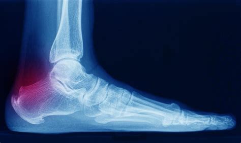 Back Of Heel Bone Spur Hot Sex Picture