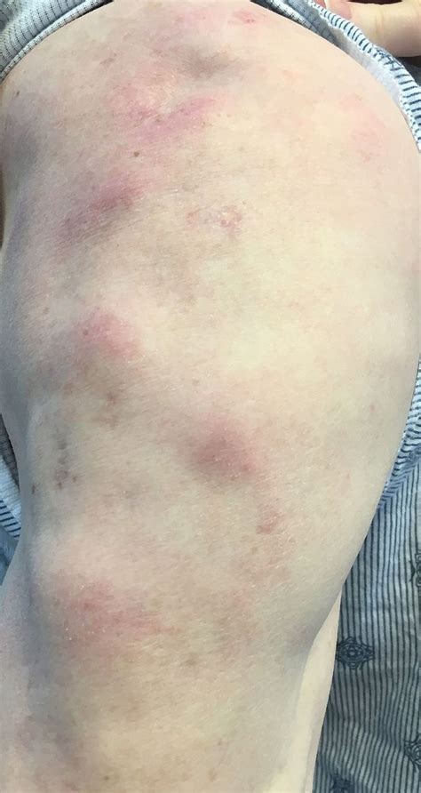 Atypical Lymphocytic Lobular Panniculitis An Overlap Condition With