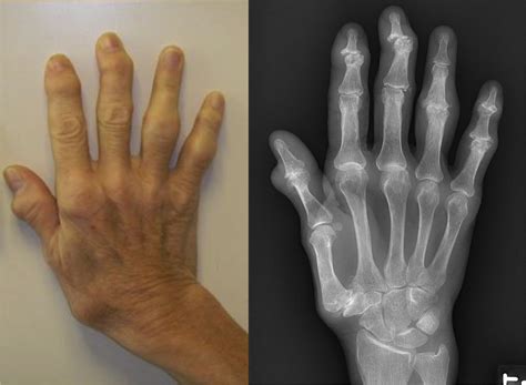 Severe Hand Osteoarthritis Strongly Correlates With Major Joint