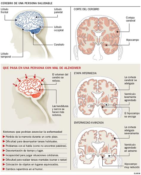 Enfermedad De Alzheimer ¿cuáles Son Las Formas De Diagnosticar La